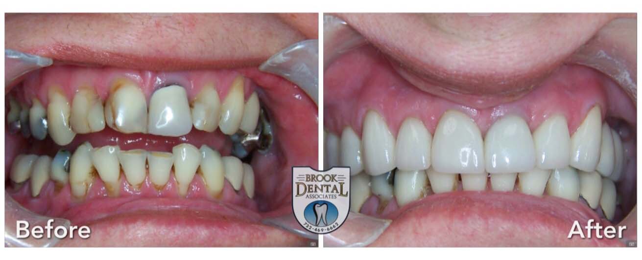 Dental Crowns Before and After NJ Dentist