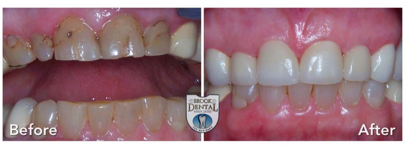 Brook Dental Crowns Before and After Pictures