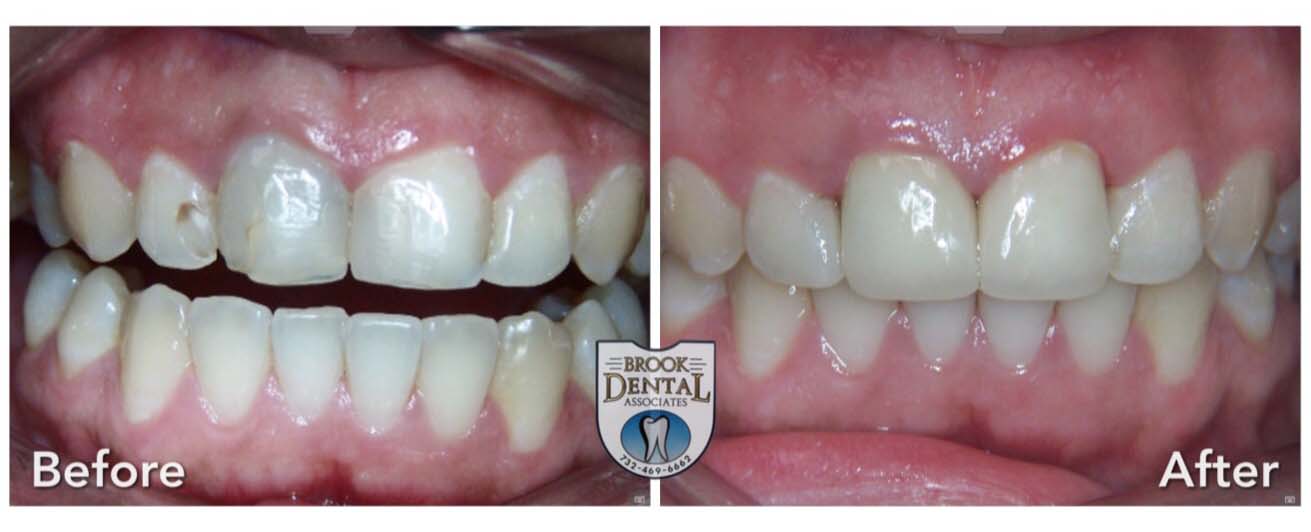 Crowns Before and After Brook Dental NJ