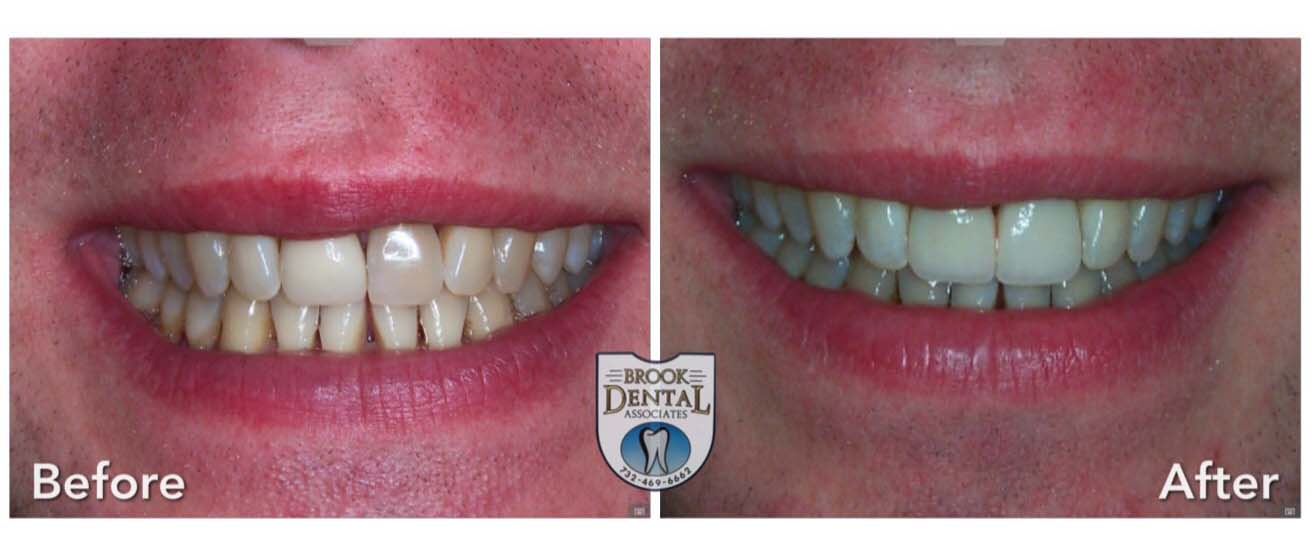 Dental Crown Before and After Bound Brook NJ Dentist